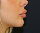 Feel Beautiful - Chin Implant 203 - After Photo